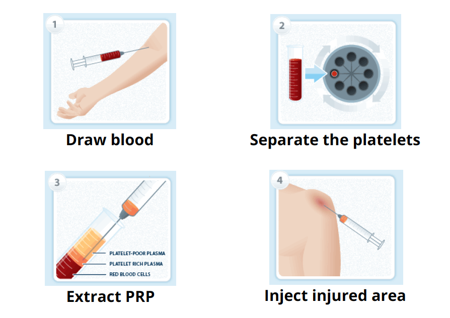 prp treatment process